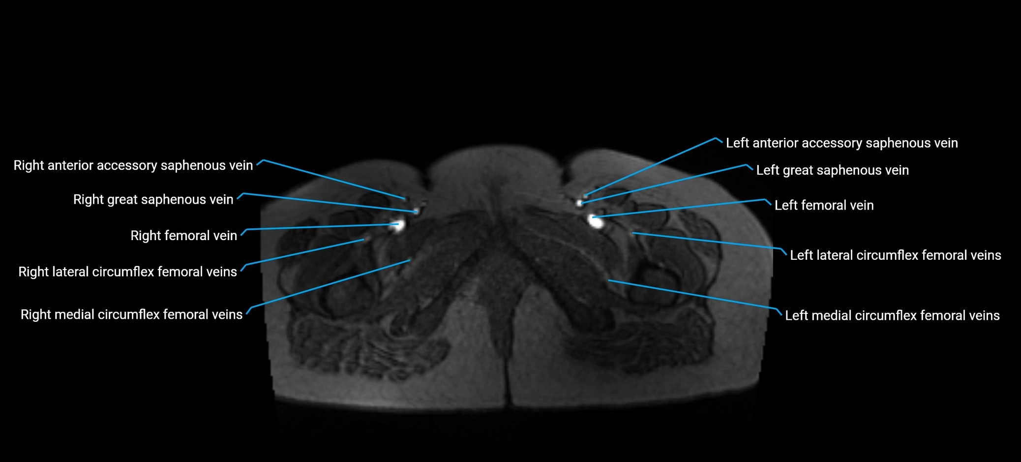 MRV abdomen pelvis & lower limb axial cross sectional anatomy labelled MRI image 201 (1).webp